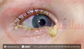 عفونت چشم نوزاد