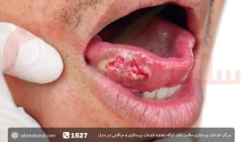 سرطان دهان چیست؛ علائم، درمان و علت ابتلا به کانسر دهان + عکس