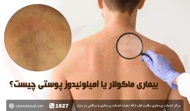 بیماری ماکولار