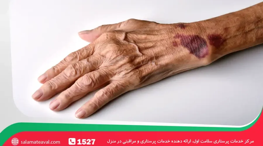 کبودی ناگهانی در سالمندان