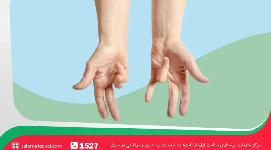 علائم کلسترول بالا در انگشتان چهارم و پنجم دست | ارتباط کلسترول با انقباض دوپویترن